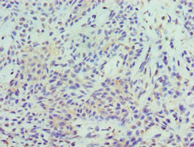 Immunohistochemistry of paraffin-embedded human breast cancer using STAT5B Antibody at dilution of 1:100Rabbit anti-Human STAT5B Polyclonal Antibody