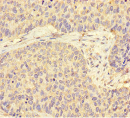 Immunohistochemistry of paraffin-embedded human ovarian cancer using STIP1 Antibody at dilution of 1:100Rabbit anti-Human STIP1 Polyclonal Antibody