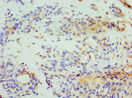 Immunohistochemistry of paraffin-embedded human breast cancer using STOM Antibody at dilution of 1:100Rabbit anti-Human STOM Polyclonal Antibody