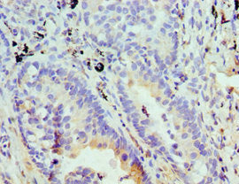 Immunohistochemistry of paraffin-embedded human lung cancer using STOM Antibody at dilution of 1:100Rabbit anti-Human STOM Polyclonal Antibody