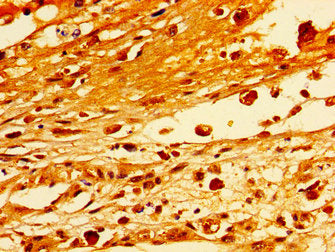 Immunohistochemistry of paraffin-embedded human melanoma using STXBP1 Antibody at dilution of 1:100