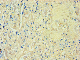 Immunohistochemistry of paraffin-embedded human lung tissue using SULT1A3 Antibody at dilution of 1:100Rabbit anti-Human SULT1A3 Polyclonal Antibody