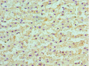 Immunohistochemistry of paraffin-embedded human liver cancer using SULT2A1 Antibody at dilution of 1:100Rabbit anti-Human SULT2A1 Polyclonal Antibody