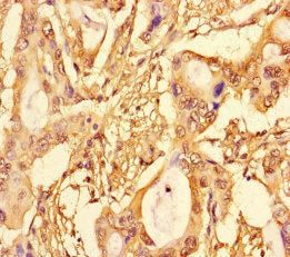 Immunohistochemistry of paraffin-embedded human pancreatic cancer using SUPT3H Antibody at dilution of 1:100Rabbit anti-Human SUPT3H Polyclonal Antibody