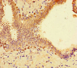 Immunohistochemistry of paraffin-embedded human prostate cancer using SUPT3H Antibody at dilution of 1:100Rabbit anti-Human SUPT3H Polyclonal Antibody