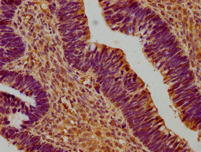IHC image of SUSD5 Antibody diluted at 1:300 and staining in paraffin-embedded human ovarian cancer performed on a Leica BondTM system. After dewaxing and hydration, antigen retrieval was mediated by high pressure in a citrate buffer (pH 6.0). Section was blocked with 10% normal goat serum 30min at RT. Then primary antibody (1% BSA) was incubated at 4°C overnight. The primary is detected by a biotinylated secondary antibody and visualized using an HRP conjugated SP system.Rabbit anti-Human SUSD5 Polyclonal Antibody