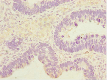 Immunohistochemistry of paraffin-embedded human ovarian cancer using SYCE1 Antibody at dilution of 1:100Rabbit anti-Human SYCE1 Polyclonal Antibody