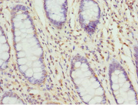 Immunohistochemistry of paraffin-embedded human colon cancer using TAGLN2 Antibody at dilution of 1:100Rabbit anti-Human TAGLN2 Polyclonal Antibody