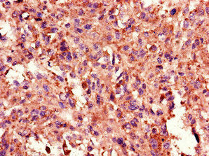 Immunohistochemistry of paraffin-embedded human melanoma using TANK Antibody at dilution of 1:100Rabbit anti-Human TANK Polyclonal Antibody
