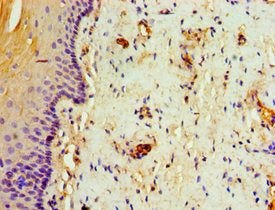 Immunohistochemistry of paraffin-embedded human cervical cancer using the antibody at dilution of 1:100Rabbit anti-Human TAP1 Polyclonal Antibody