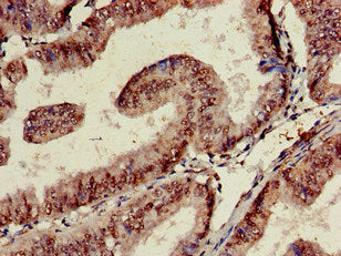 Immunohistochemistry of paraffin-embedded human endometrial cancer using TARDBP Antibody at dilution of 1:100Rabbit anti-Human TARDBP Polyclonal Antibody