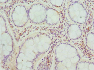 Immunohistochemistry of paraffin-embedded human colon cancer using TARS Antibody at dilution of 1:100Rabbit anti-Human TARS Polyclonal Antibody