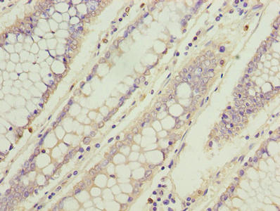 Immunohistochemistry of paraffin-embedded human colon cancer using TBCC Antibody at dilution of 1:100Rabbit anti-Human TBCC Polyclonal Antibody