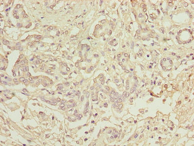Immunohistochemistry of paraffin-embedded human pancreatic cancer using TBCC Antibody at dilution of 1:100Rabbit anti-Human TBCC Polyclonal Antibody
