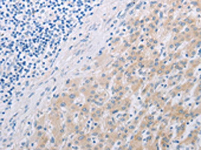 The image on the left is immunohistochemistry of paraffin-embedded Human liver cancer tissue using PFN2 Antibody(PFN2 Antibody) at dilution 1/30, on the right is treated with synthetic peptide. (Original magnification: ×200)Rabbit anti-Human PFN2 Polyclonal Antibody