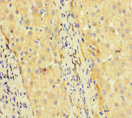 Immunohistochemistry of paraffin-embedded human liver cancer using TCF4 Antibody at dilution of 1:100Rabbit anti-Human TCF4 Polyclonal Antibody