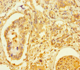 Immunohistochemistry of paraffin-embedded human pancreatic cancer using TCF4 Antibody at dilution of 1:100Rabbit anti-Human TCF4 Polyclonal Antibody