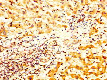 IHC image of the antibody diluted at 1:800 and staining in paraffin-embedded human liver cancer performed on a Leica BondTM system. After dewaxing and hydration, antigen retrieval was mediated by high pressure in a citrate buffer (pH 6.0). Section was blocked with 10% normal goat serum 30min at RT. Then primary antibody (1% BSA) was incubated at 4°C overnight. The primary is detected by a biotinylated secondary antibody and visualized using an HRP conjugated SP system.Rabbit anti-Human TCP1 Polyclonal Antibody