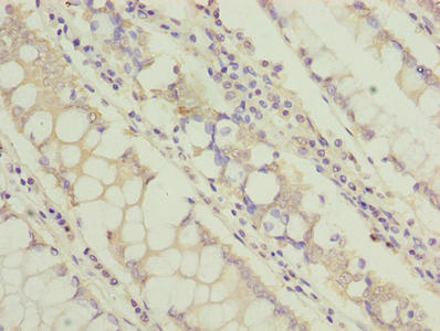Immunohistochemistry of paraffin-embedded human colon cancer using TCTA Antibody at dilution of 1:100Rabbit anti-Human TCTA Polyclonal Antibody
