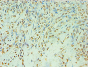 Immunohistochemistry of paraffin-embedded human breast cancer using TDP1 Antibody at dilution of 1:100Rabbit anti-Human TDP1 Polyclonal Antibody