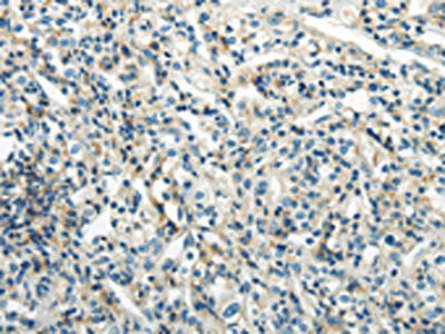 The image on the left is immunohistochemistry of paraffin-embedded Human prostate cancer tissue using PDPN Antibody(PDPN Antibody) at dilution 1/25, on the right is treated with synthetic peptide. (Original magnification: ×200)Rabbit anti-Human PDPN Polyclonal Antibody