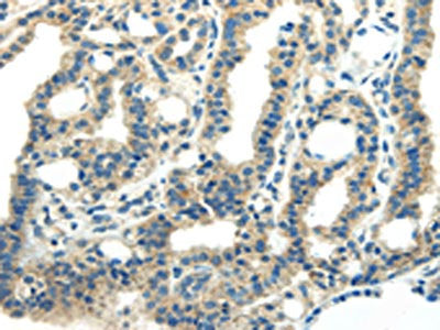 The image on the left is immunohistochemistry of paraffin-embedded Human thyroid cancer tissue using the antibody Antibody) at dilution 1/25, on the right is treated with synthetic peptide. (Original magnification: ×200)Rabbit anti-Human PDPN Polyclonal Antibody