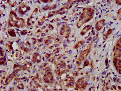 IHC image of TFB1M Antibody diluted at 1:500 and staining in paraffin-embedded human pancreatic cancer performed on a Leica BondTM system. After dewaxing and hydration, antigen retrieval was mediated by high pressure in a citrate buffer (pH 6.0). Section was blocked with 10% normal goat serum 30min at RT. Then primary antibody (1% BSA) was incubated at 4°C overnight. The primary is detected by a biotinylated secondary antibody and visualized using an HRP conjugated SP system.