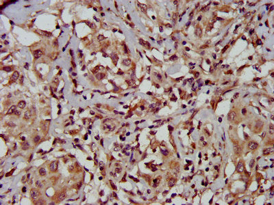 IHC image of TFB1M Antibody diluted at 1:500 and staining in paraffin-embedded human liver cancer performed on a Leica BondTM system. After dewaxing and hydration, antigen retrieval was mediated by high pressure in a citrate buffer (pH 6.0). Section was blocked with 10% normal goat serum 30min at RT. Then primary antibody (1% BSA) was incubated at 4°C overnight. The primary is detected by a biotinylated secondary antibody and visualized using an HRP conjugated SP system.