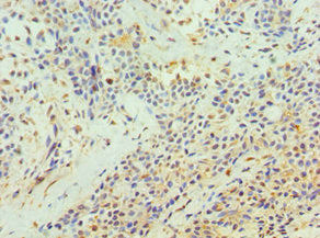 Immunohistochemistry of paraffin-embedded human breast cancer using the antibody at dilution of 1:100Rabbit anti-Human TFPI2 Polyclonal Antibody