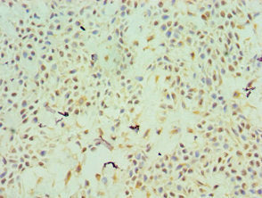 Immunohistochemistry of paraffin-embedded human breast cancer using TFPI2 Antibody at dilution of 1:100Rabbit anti-Human TFPI2 Polyclonal Antibody