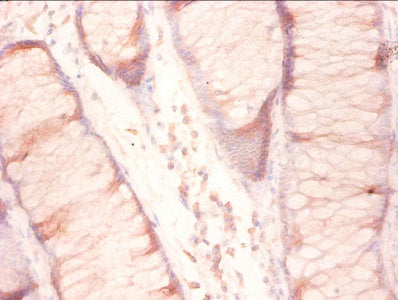 Immunohistochemistry of paraffin-embedded human colon cancer using RPL27 Antibody at diluton of 1:50Rabbit anti-Human RPL27 Polyclonal Antibody