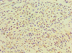 Immunohistochemistry of paraffin-embedded human breast cancer using TGM2 Antibody at dilution of 1:100Rabbit anti-Human TGM2 Polyclonal Antibody