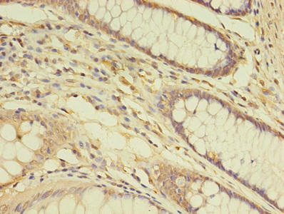 Immunohistochemistry of paraffin-embedded human colon cancer using THRA Antibody at dilution of 1:100Rabbit anti-Human THRA Polyclonal Antibody