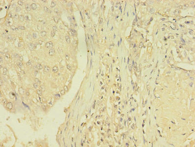 Immunohistochemistry of paraffin-embedded human lung cancer using THRB Antibody at dilution of 1:100Rabbit anti-Human THRB Polyclonal Antibody