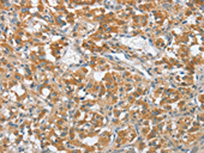 The image on the left is immunohistochemistry of paraffin-embedded Human thyroid cancer tissue using ENTPD5 Antibody(ENTPD5 Antibody) at dilution 1/20, on the right is treated with fusion protein. (Original magnification: ×200)Rabbit anti-Human ENTPD5 Polyclonal Antibody