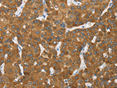 The image on the left is immunohistochemistry of paraffin-embedded Human liver cancer tissue using the antibody Antibody) at dilution 1/20, on the right is treated with fusion protein. (Original magnification: ×200)Rabbit anti-Human ENTPD5 Polyclonal Antibody