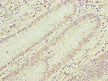 Immunohistochemistry of paraffin-embedded human colon cancer using TIMM17B Antibody at dilution of 1:100Rabbit anti-Human TIMM17B Polyclonal Antibody