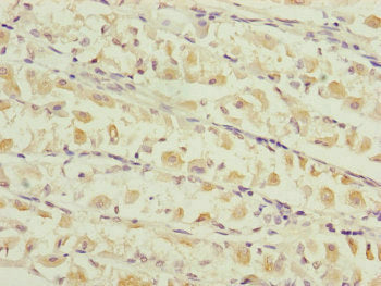 Immunohistochemistry of paraffin-embedded human gastric cancer using TIMM17B Antibody at dilution of 1:100Rabbit anti-Human TIMM17B Polyclonal Antibody