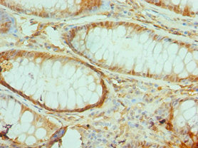 Immunohistochemistry of paraffin-embedded human colon cancer using TIRAP Antibody at dilution of 1:100Rabbit anti-Human TIRAP Polyclonal Antibody