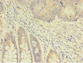 Immunohistochemistry of paraffin-embedded human colon cancer using TK1 Antibody at dilution of 1:100Rabbit anti-Human TK1 Polyclonal Antibody