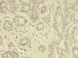 Immunohistochemistry of paraffin-embedded human breast cancer using TK1 Antibody at dilution of 1:100Rabbit anti-Human TK1 Polyclonal Antibody