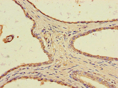 Immunohistochemistry of paraffin-embedded human prostate cancer using the antibody at dilution of 1:100Rabbit anti-Human TLL1 Polyclonal Antibody