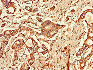 Immunohistochemistry of paraffin-embedded human pancreatic cancer using the antibody at dilution of 1:100Rabbit anti-Human TLR3 Polyclonal Antibody