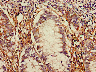 Immunohistochemistry of paraffin-embedded human colon cancer using TLR5 Antibody at dilution of 1:100Rabbit anti-Human TLR5 Polyclonal Antibody