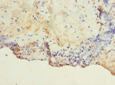 Immunohistochemistry of paraffin-embedded human breast cancer using TM4SF1 Antibody at dilution of 1:100Rabbit anti-Human TM4SF1 Polyclonal Antibody