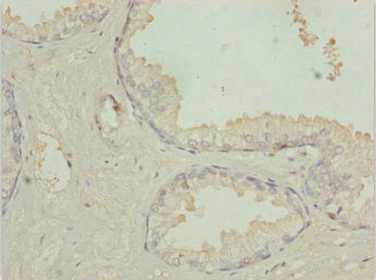 Immunohistochemistry of paraffin-embedded human prostate cancer using TM9SF1 Antibody at dilution of 1:100Rabbit anti-Human TM9SF1 Polyclonal Antibody
