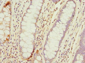 Immunohistochemistry of paraffin-embedded human colon cancer using TMED10 Antibody at dilution of 1:100Rabbit anti-Human TMED10 Polyclonal Antibody