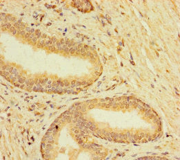 Immunohistochemistry of paraffin-embedded human prostate cancer using TMEM120B Antibody at dilution of 1:100Rabbit anti-Human TMEM120B Polyclonal Antibody