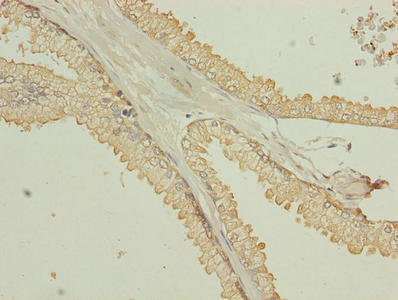 Immunohistochemistry of paraffin-embedded human prostate cancer using TMEM140 Antibody at dilution of 1:100Rabbit anti-Human TMEM140 Polyclonal Antibody