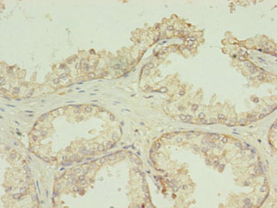 Immunohistochemistry of paraffin-embedded human prostate cancer using TMEM141 Antibody at dilution of 1:100Rabbit anti-Human TMEM141 Polyclonal Antibody